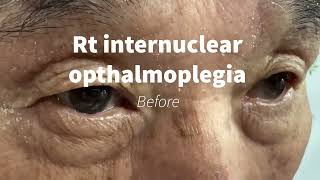 Internuclear opthalmoplegia immediately improved [upl. by Sharona682]