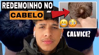 REDEMOINHO NO CABELO MASCULINO  É NORMAL É CALVICE  O QUE É O REDEMOINHO CABELO FEMININO [upl. by Basham]