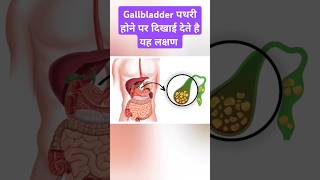 Symptoms of Gallbladder stone Gallbladder shorts ytshorts [upl. by Frida]