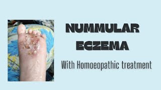 Numular eczema [upl. by Lunette]