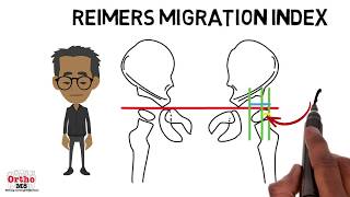 Radiographic features  Reimers Migration Index [upl. by Etteb]