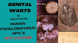 GENITAL WARTS  HPV IN MALAYALAM  Symptoms Who What amp When To Test Treatments Stages amp Testing [upl. by Rachelle]