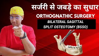 Dr Rudra Mohan सर्जरी से जबड़े का सुधार Bilateral Sagittal Split Osteotomy Jaw Correction Surgery [upl. by Boutis]