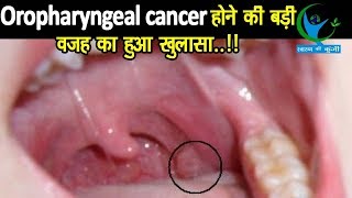 Oropharyngeal Cancer मुख और गले के कैंसर मरीजों के आंकड़ों को सुनकर दंग रह जायेंगे लक्षण और उपचार [upl. by Leschen232]