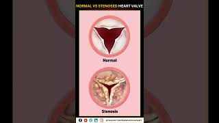 Normal vs Narrowed Stenosed Heart Valve education neet biology heart [upl. by Eehsar]