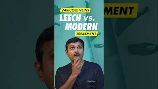 Can Leech Therapy REALLY Cure Varicose Veins [upl. by Warford798]