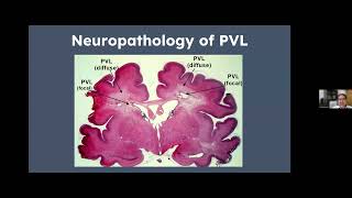 NSGR Vulnerability of the Preterm Brain amp Periventricular Leukomalacia Dr Michael Kruer 81224 [upl. by Aramal]