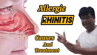 Allergic Rhinitis Causes and Treatment [upl. by Chernow]