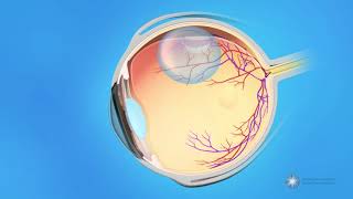 Pneumatic Retinopexy for Detached Retina [upl. by Lladnarc]