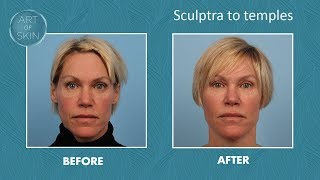 Sculptra injection to temples [upl. by Erdnassak]