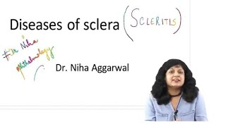 Diseases of Sclera  Dr Niha Aggarwal [upl. by Attelliw]