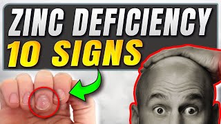 Boost Your Health 10 Zinc Deficiency Symptoms [upl. by Alian729]