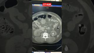 CT KUB shorts radiology [upl. by Milan]