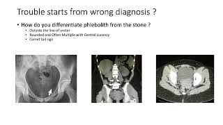 Phlebolith vs Lower Ureteric Stone  How to Diffrentiate [upl. by Evetta]