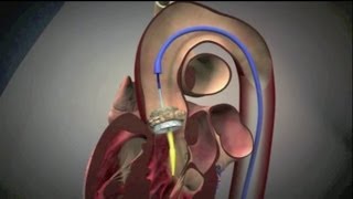 Transcatheter Aortic Valve Implantation TAVI [upl. by Lekram]