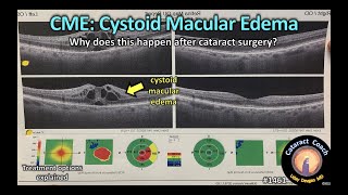 CataractCoach 1461 cystoid macular edema CME after cataract surgery [upl. by Eybbob]