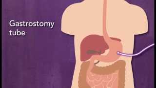 Why are there different types of feeding tubes [upl. by Hassin]