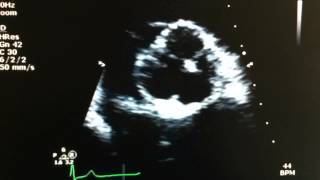 Quadricuspid Aortic Valve [upl. by Aileduab]