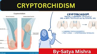 Cryptorchidism  Nursing Classes  Pediatric Nursing  Easy Explanation in Hindi [upl. by Anitsyrhc]