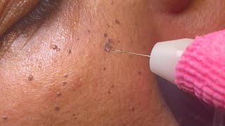 DPN Dermatosis Papulosa Nigra Removal [upl. by Ihculo]