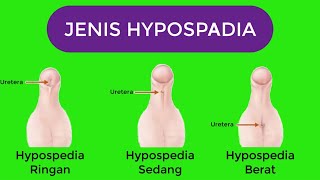 HIPOSPADIA DAN EPISPADIA PADA BAYI LAKILAKI [upl. by Lemrac]