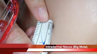 Intradermal Nevus on Cheek Removal Surgery HD 여성의 뺨에 큰 점 진피내모반 을 수술로 제거하는 방법 수원 광교 유디트성형외과 닥터랜사부 [upl. by Smeaj]