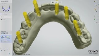 Fabrication of the BruxZir® FullArch Implant Prosthesis Vol 1 Issue 2 [upl. by Llenor622]