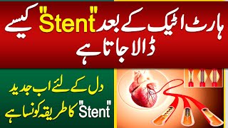 Heart Stent Procedure  Heart Stent Kaise Dalte Hain  Heart Attack Stent Procedure [upl. by Egwin]