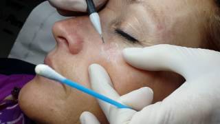 LAMPROBE removal of Solar Keratosis by Janine Thomson [upl. by Aylmer286]