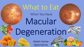 What to Eat When You Have Macular Degeneration  ARMD  Wet ARMD  Dry ARMD [upl. by Nnaihs289]