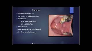 9 Neoplasias Benignas [upl. by Leffert]