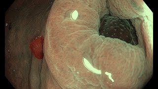 Polyp in appendix [upl. by Igig142]