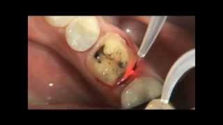 PHILIPS LASERS Eviction gingivale 3wmv [upl. by Duj505]