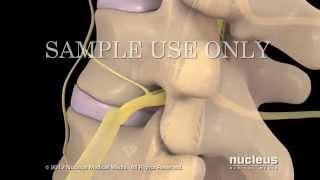 Lesiones de disco lumbar y tratamiento [upl. by Itsyrc]