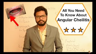 Angular Cheilitis Simplified [upl. by Rafat]