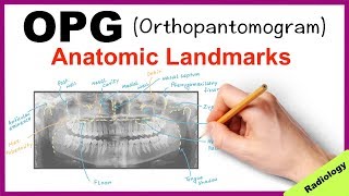 Orthopantomogram OPG Anatomical Landmarks  Radiology [upl. by Zampino]