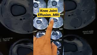 Knee Joint EffusionKnee MRIDr Sai Chandra [upl. by Nirb346]