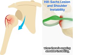 Shoulder Dislocation And Hill Sachs Lesion [upl. by Edlin714]