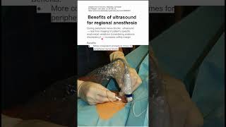 Benefits of ultrasound for regional anesthesia [upl. by Martelle166]