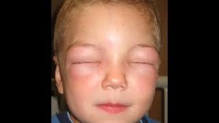 Anaphylaxis due to Drug allergy [upl. by Ainezey]