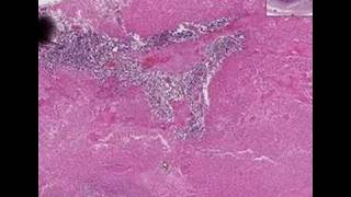 Histopathology Testis Embryonal carcinoma [upl. by Beauvais]