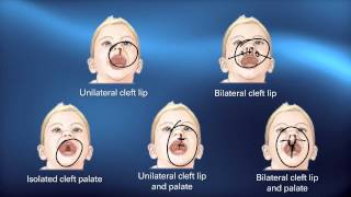 Cleft Diagnosis  Pediatric Playbook  Boston Childrens Hospital [upl. by Most101]