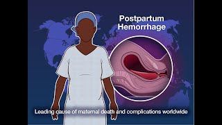 Early Detection and Treatment of Postpartum Hemorrhage  NEJM [upl. by Nahraf]