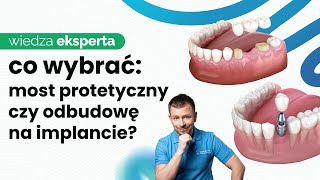 MOST NA IMPLANTACH A MOST NA ZÄBACH NATURALNYCH  KLUCZOWE RĂ“Ĺ»NICE [upl. by Alhan360]