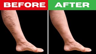 10 Natural Ways to Get Rid of Varicose Veins and Increase Blood Flow  HEALTHPECIAL [upl. by Baudin]