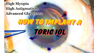 Basics of TORIC IOL [upl. by Silverstein]