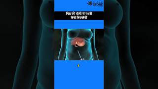 Gall bladder stone removal  Laproscopic Cholecystectomy  shortsviral [upl. by Windham253]