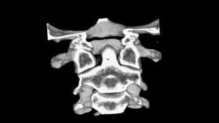 Cervical spine CT scan Atlantoaxial subluxation [upl. by Fishbein]