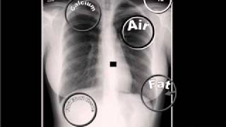 01 The 5 Basic Radiographic Densities [upl. by Elspeth]