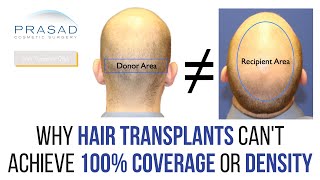 Why Hair Transplants Cannot Achieve 100 Coverage or Density and Getting Density NonSurgically [upl. by Peskoff]